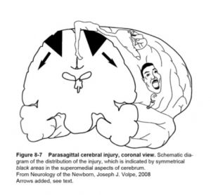 Intrathecal Baclofen Pump In Cerebral Palsy – KAREN PAPE, MD