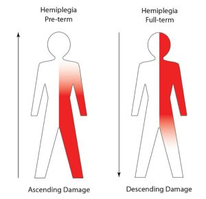 Cerebral Palsy: The Timing of Damage is Important – KAREN PAPE, MD